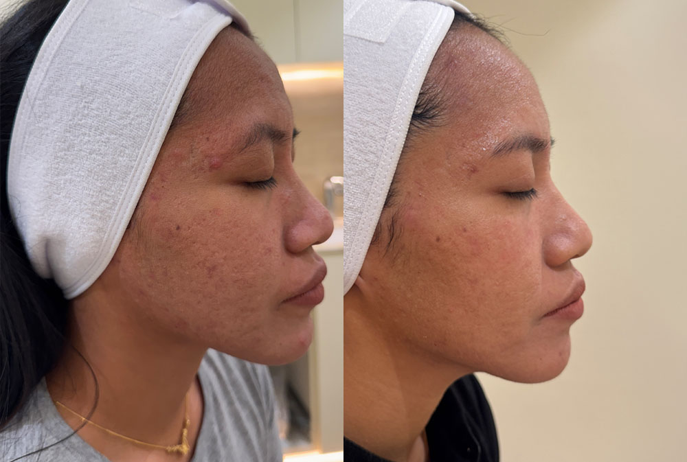 Acne and medical dermatology treatment in Bali