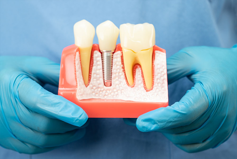 Dental Implants Bali