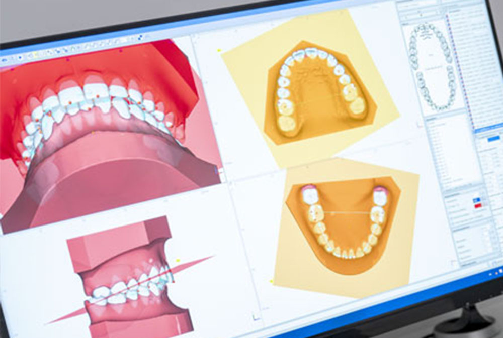 Digital orthodontic treatment planning with advanced dental technology for accurate results in Bali