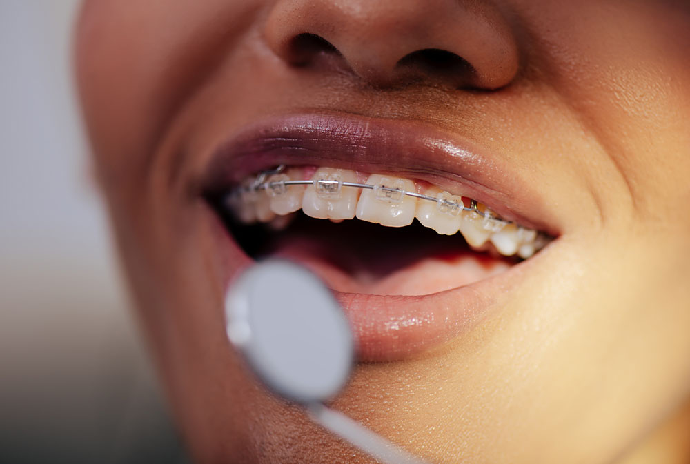 Traditional fixed orthodontic braces treatment for precise teeth alignment in Bali