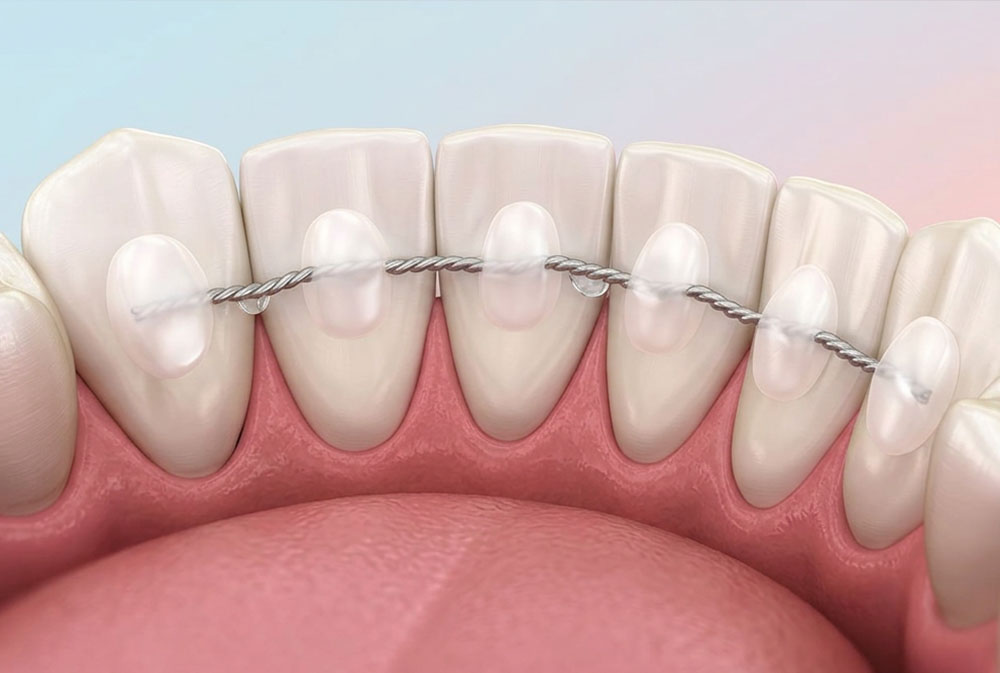 Customized orthodontic retainers used after braces treatment for long-term teeth alignment in Bali